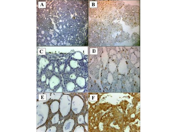 Immunohistochemistry using Telomerase catalytic subunit Antibody Immunohistochemistry using Telomerase catalytic subunit Antibody