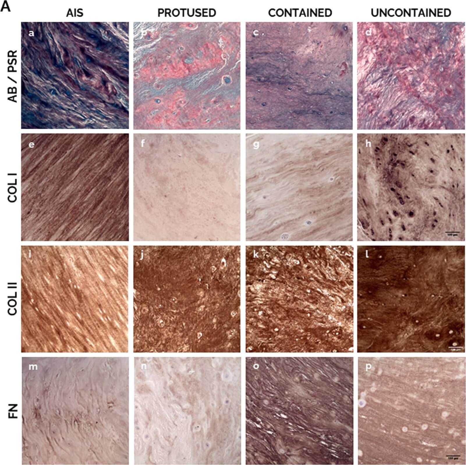 IHC of Anti-Collagen Type I IHC of Anti-Collagen Type I